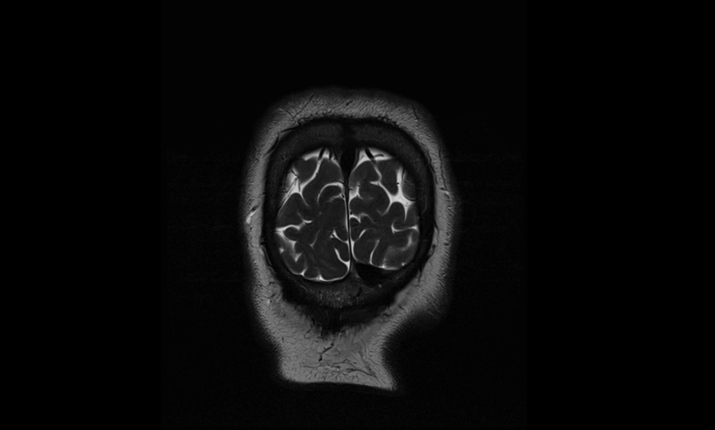 Brain cisterns  and ventricles coronal anatomy 3T MRI image-img-00001-00061.webp